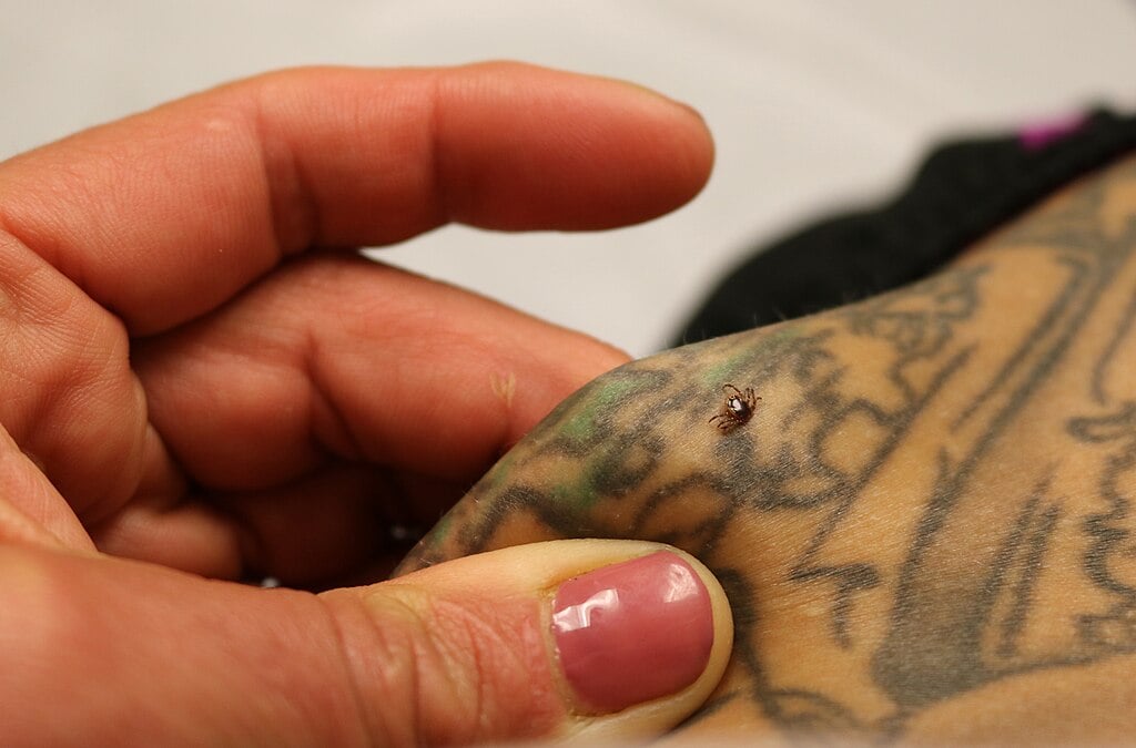 lone star tick burrowed into a person